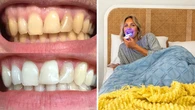 Award-winning teeth whitening kit drops to 60 per cent off: ‘I noticed instant results after the first use.’