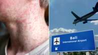 Highly infectious disease spreads in two states as new cases linked to Bali travel