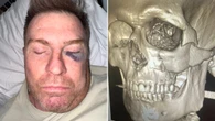 AFL cult hero set for facial surgery after frightening accident