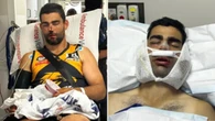 Local footy captain still fighting after ‘traumatic’ facial injury