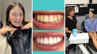 Teeth whitening kit that promises professional-level results at home discounted