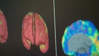 ‘It’s vital’: New Alzheimer's drug offers hopes