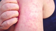 Infectious disease alert at tourist hot spot following multiple confirmed cases