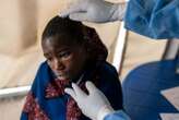 How deadly is mpox and what treatments are available?