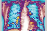 Catching a cold can delay cancer from spreading to the lungs