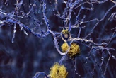 Huge study of Alzheimer’s genetics identifies new drug targets