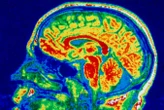Brain changes with eating disorders similar to those in OCD and autism