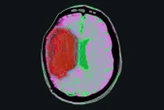 Chilling the body with drugs could limit brain damage from stroke