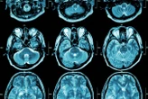 Autism may have two distinct subtypes that vary by brain activity