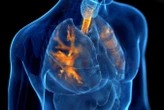 Inhalable nanoparticles could help treat chronic lung disease