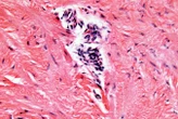 Unpicking endometriosis reveals how it affects more than the pelvis