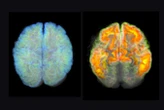 2023 saw a cautious hope for Alzheimer's treatment but doubts remain