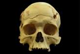 Skull shows man survived surgery to ease brain pressure 2700 years ago