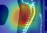 Radioactive ion beam could target tumours more precisely