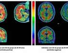 SÃ­ndrome de Down: tÃ©cnica de medicina nuclear estuda Alzheimer nesse grupo