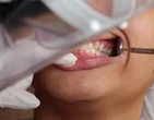 Descoberta substÃ¢ncia (secretada por fungos) para combater cÃ¡rie dental