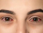 Semana Mundial da Alergia: quatro tipos de conjuntivite e como tratar