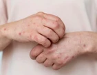 NÃºmero de internaÃ§Ãµes causadas por herpes zoster cresce no Brasil