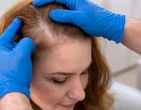 NÃ£o Ã© sÃ³ para eles: transplante capilar Ã© cada vez mais procurado pelo pÃºblico feminino