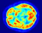 Estudo identifica marcadores para os 5 estÃ¡gios clÃ­nicos do Parkinson