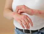 Paralisia facial, perda de audiÃ§Ã£o e equilÃ­brio: reaÃ§Ãµes da herpes zÃ³ster