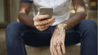 Vitiligo : le premier traitement arrive pour le million de Français touchés par cette maladie de la peau