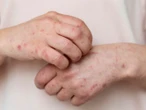 Alerta NL por riesgo de contagios de sarampión ante temporada vacacional