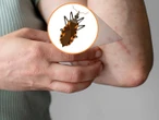 Chagas, una enfermedad que azota sin tregua