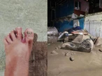 Pobladores de Poza Rica, Veracruz, empiezan a presentar afectaciones dermatológicas