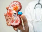 Fumar causa cáncer de riñón: especialistas advierten sobre los riesgos