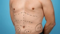 Peito grande em homens: por que acontece e quando a cirurgia é indicada