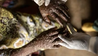 OMS mantém alerta global para epidemia de Mpox