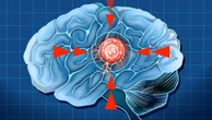 Glioblastoma: o tumor cerebral mais agressivo e o desafio da medicina moderna