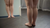 Médicos de familia recuerdan que los medicamentos contra la obesidad deben acompañarse de cambios en el estilo de vida