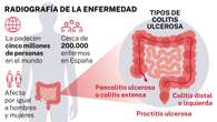 Llega a España una nuevo tratamiento para pacientes con colitis ulcerosa apto para adolescentes