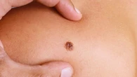Las diferencias entre un lunar sano y uno cancerígeno: las claves para detectar el cáncer más agresivo que no para de aumentar en España