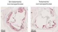 Investigadores españoles desarrollan un tratamiento para frenar la acumulación de colesterol en las arterias