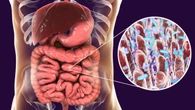 Cáncer de estómago: el 76% de los casos estarán relacionados con una infección común que se puede prevenir