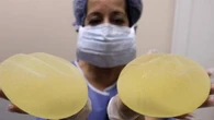 Sanidad confirma más de 100 casos de un raro cáncer relacionado con implantes de mama en España