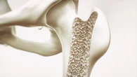Osteoporosis: qué es, síntomas más comunes y el avance que podría revolucionar su diagnóstico