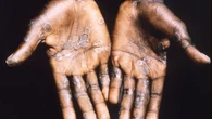 La OMS alerta de que la transmisión del virus mpox continúa, con casos en 26 países