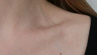 Por qué salen verrugas en zonas como el cuello y axilas (y cómo tratarlas en casa)