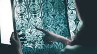 Células inmunes para combatir las proteínas que dañan el cerebro
