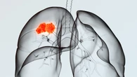 La inmunoterapia o terapias dirigidas se asocian a menor riesgo de un segundo cáncer supervivientes cáncer de pulmón