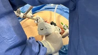 Primeros casos en España con un nueva endograpadora automática para cirugía bariátrica