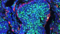 Convierten estas células en el mayor enemigo del cáncer: es un salto impresionante