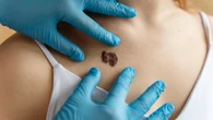 Golpe contra el cáncer de piel: logran multiplicar por cuatro el tiempo de supervivencia