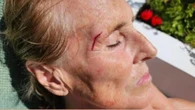 Mercedes Milá sufre un accidente doméstico y así ha quedado su cara