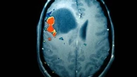 Investigadores encuentran relación entre sufrir un traumatismo en la cabeza con tumores cerebrales