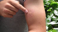 ¿Qué insecto me ha picado? Así lucen las diferentes picaduras